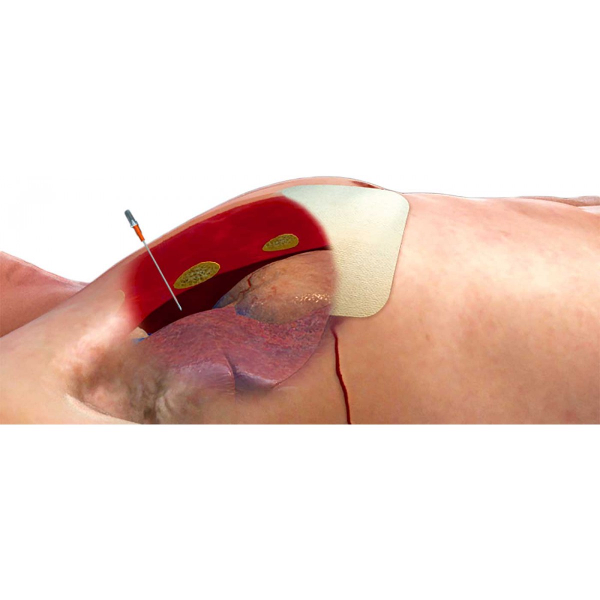 Ars For Needle Decompression