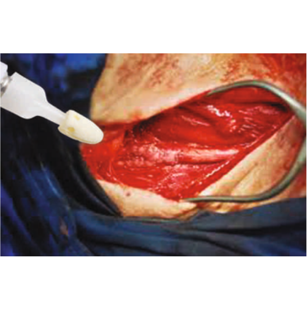 Micro Tissue Adhesives